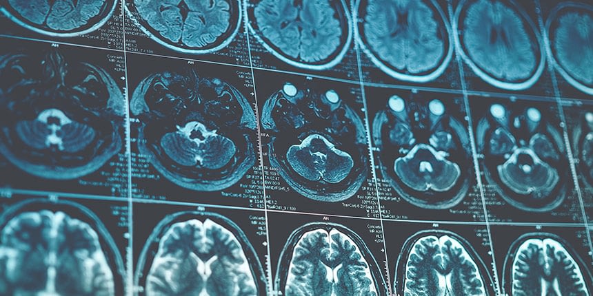 Le scanner cérébral et l'IRM cérébrale sont les examens les plus fréquemment pratiqués Tumeur au cerveau : les examens