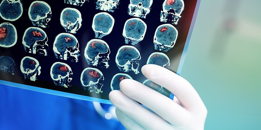 Causes des tumeurs cérébrales Les causes des tumeurs au cerveau